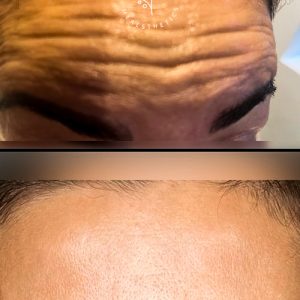 Anti-Wrinkle+(Botox)+in+Romford+-+image00009