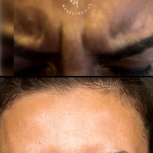 Anti-Wrinkle+(Botox)+in+Romford+-+image00012