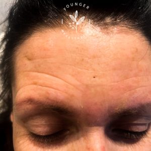 Anti-Wrinkle+(Botox)+in+Romford+-+image00014