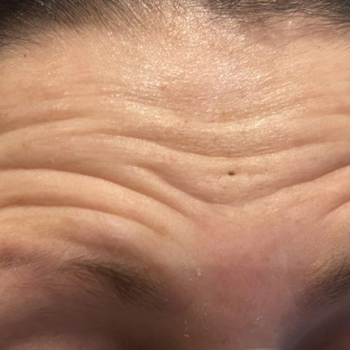 Anti-Wrinkle+(Botox)+in+Romford+-+image00013